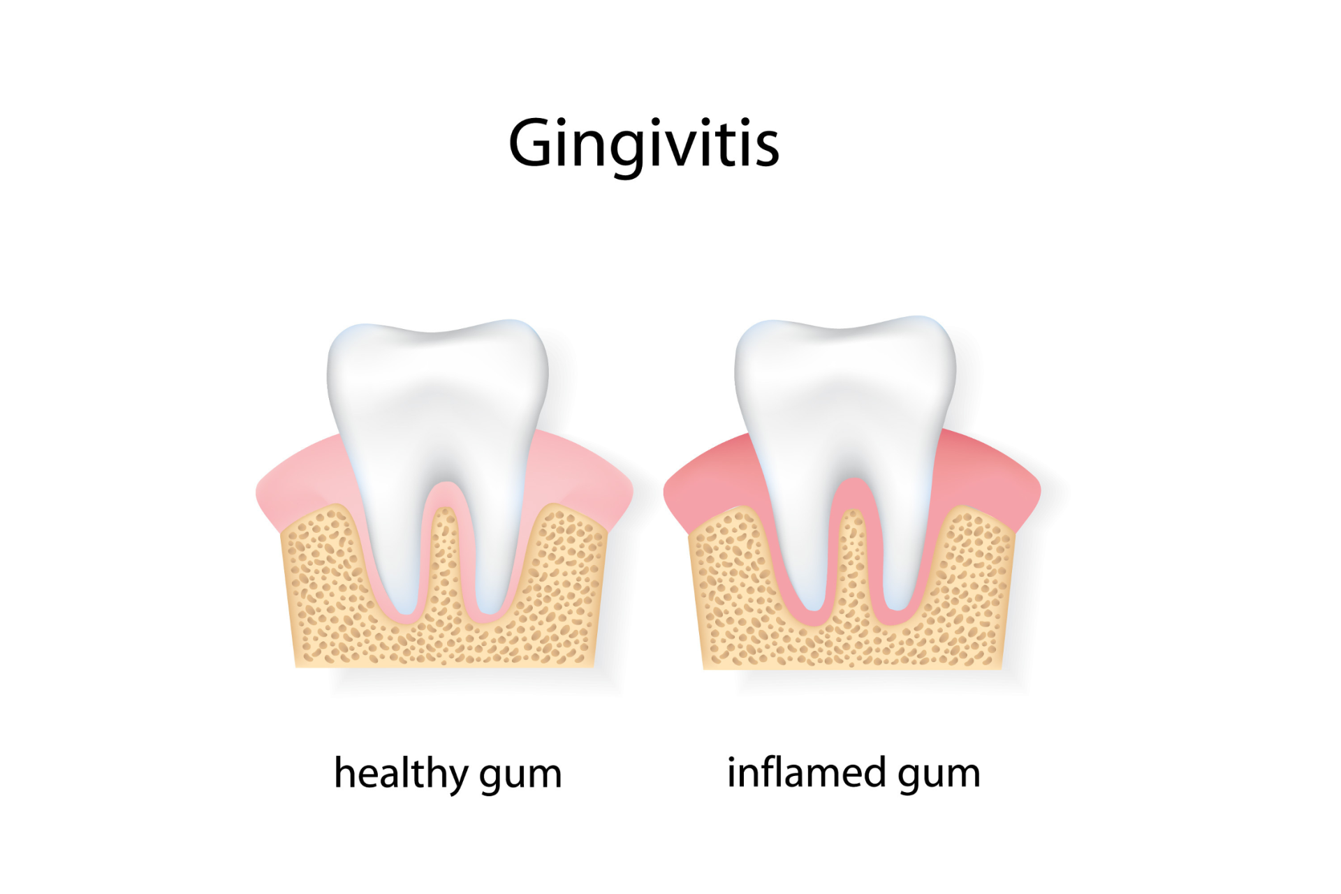 gingivitis treatment