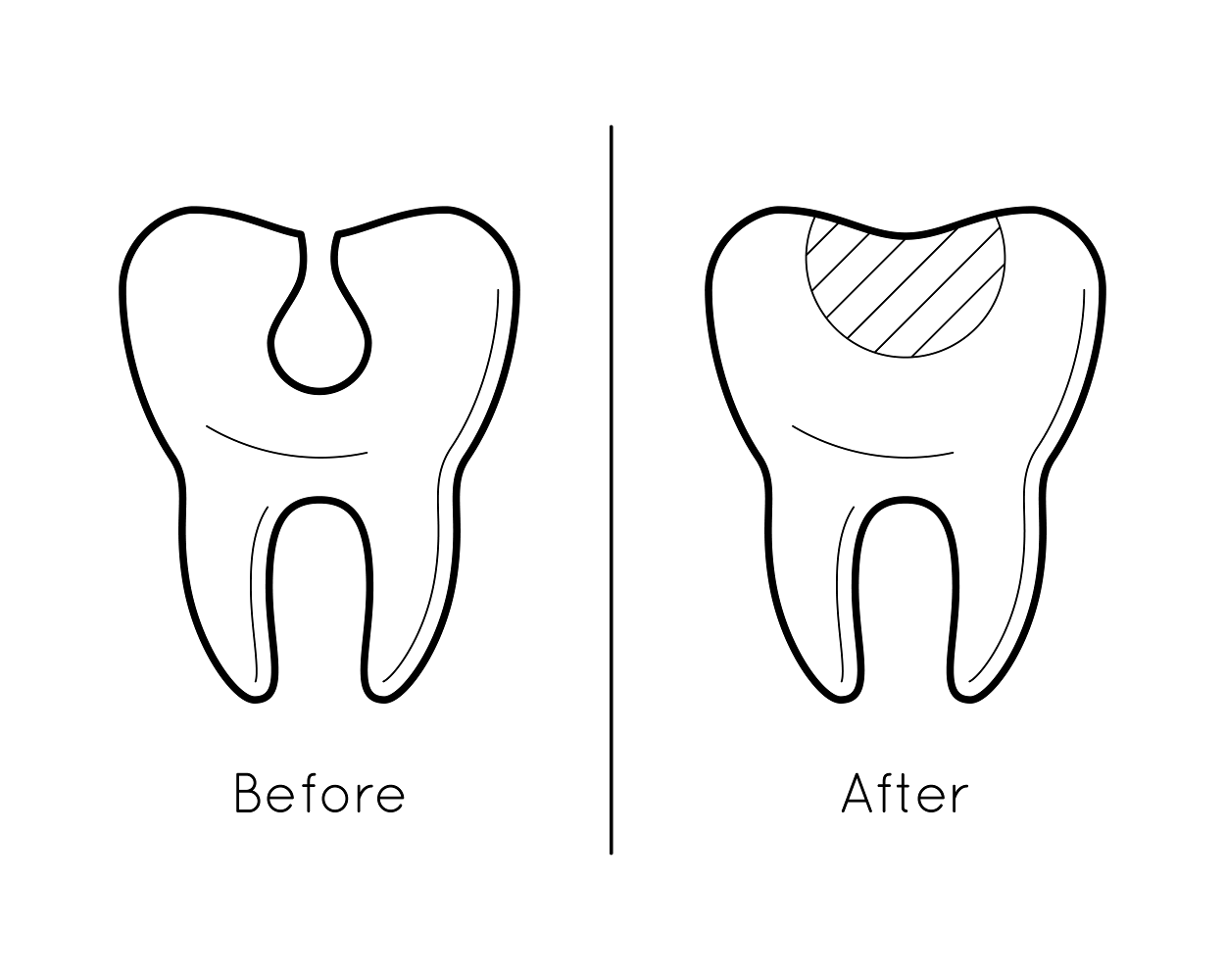 tooth enamel loss